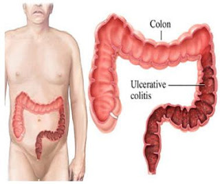 Colitis_Symptoms_Cure_Treatment_Attack_Causes_Home_Herbal_Natural Remedies_Pain_Prevention_Risk Factors.jpg